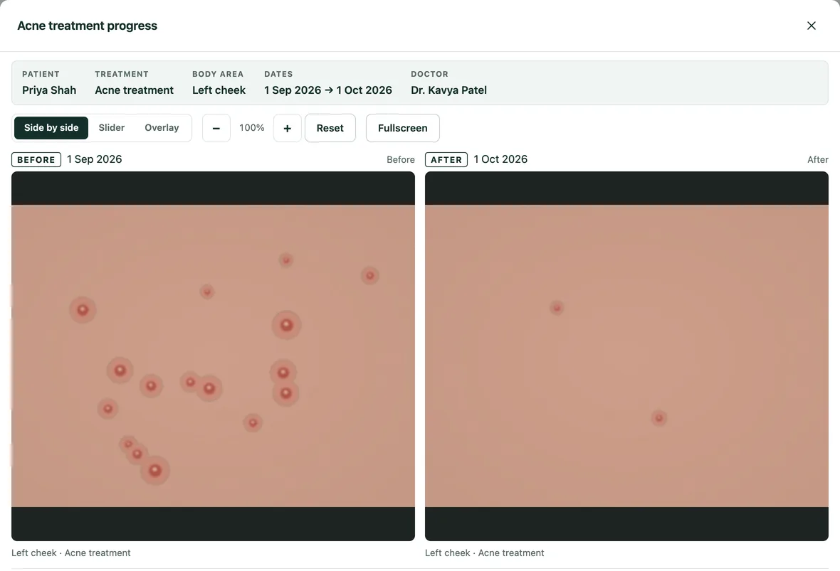 Before and after comparison of clinical photos for an acne treatment.
